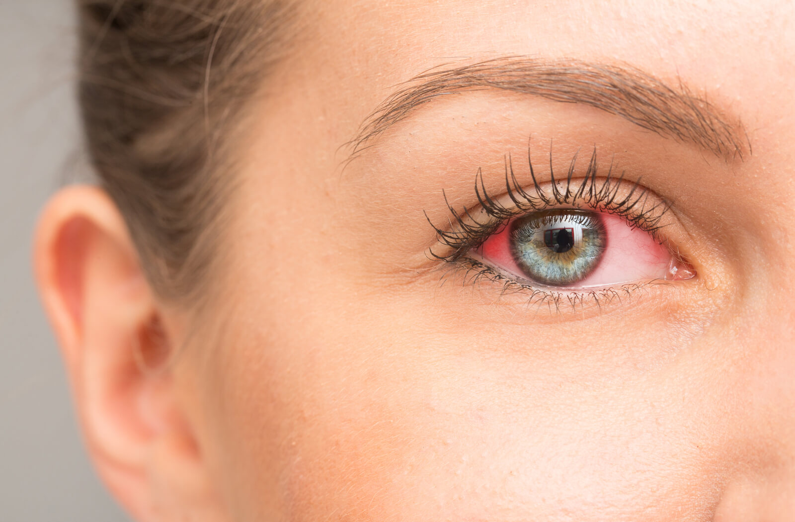 a close up image of a woman's eye which is red due to infection